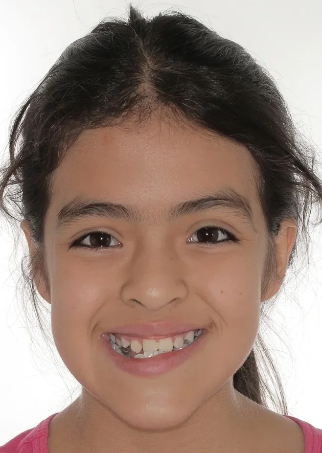 Fotografía clínica de María Isabel sonriendo a los 11 años