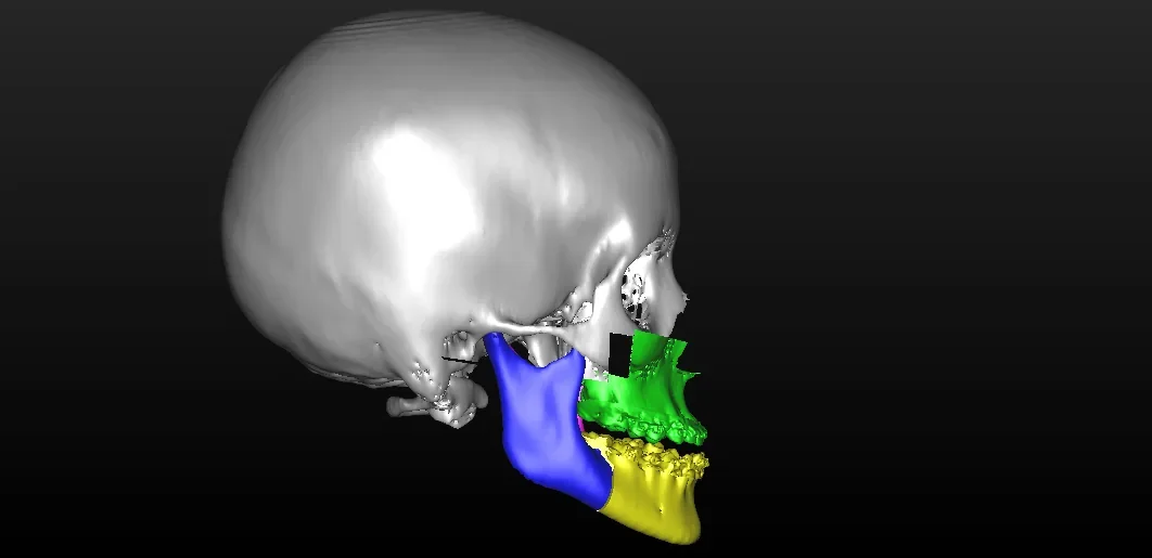 Imagen del modelo de planificación quirúrgica virtual