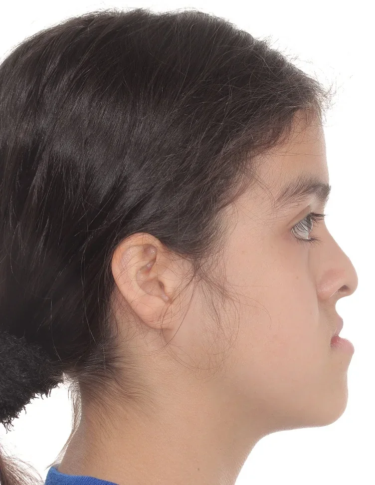 Perfil de María Isabel antes de la cirugía, a los 13,9 años